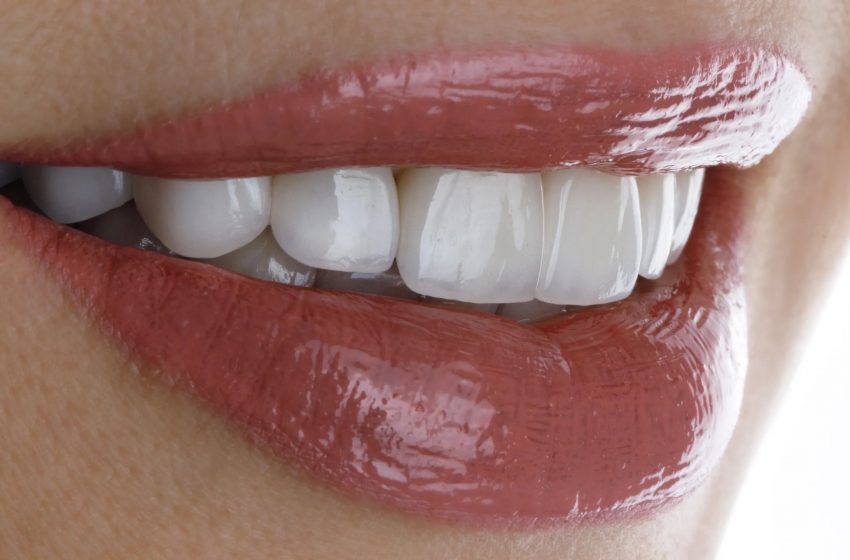 Facette dentaire en Algérie, un sourire parfait grâce aux facettes dentaires