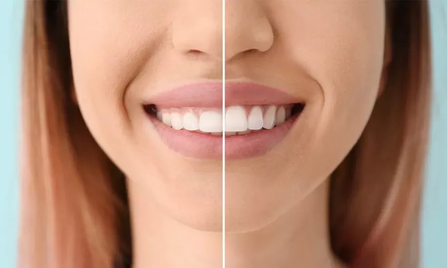 sourire gingival causes symptômes et traitements en Algérie